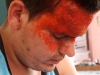 Burns on his face.
